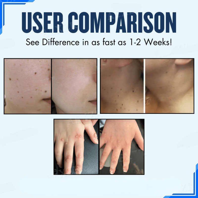 ClearSkin™ | Retrouver confiance et beauté