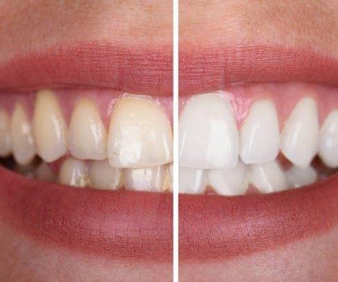 SmileKit™ | Vous vous sentez plus confiant avec un sourire frais et radieux qui dure