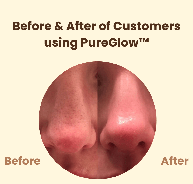 PureGlow™ | Éclat naturel et confiance retrouvée
