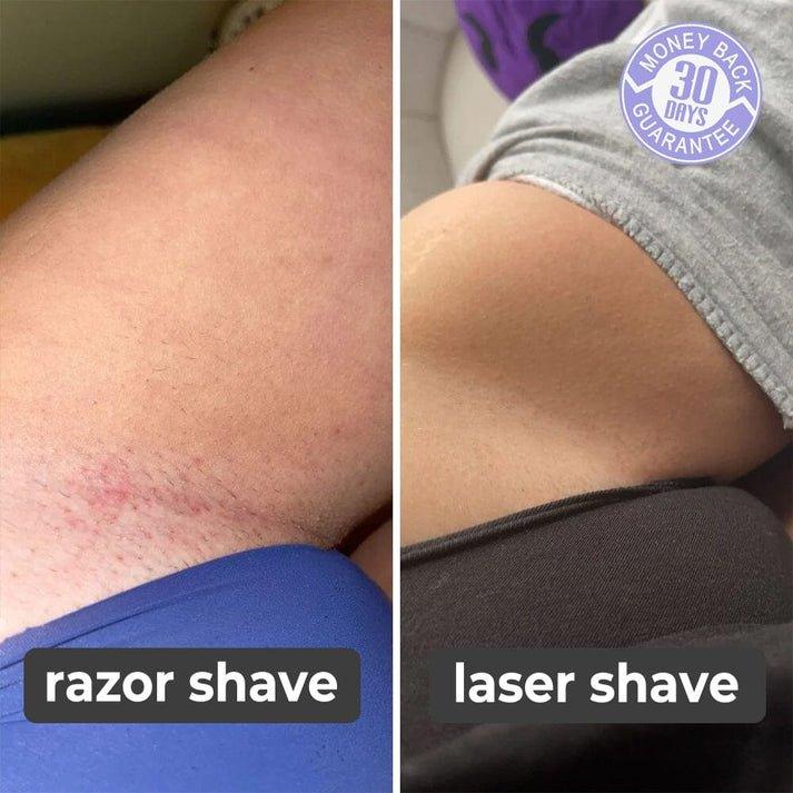 SmoothBeam™ - Épilation Laser Sans Douleur à Domicile pour Corps, Visage et Bikini